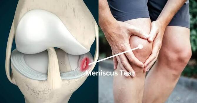 Could Your Inner Knee Pain Be a Meniscus Injury?